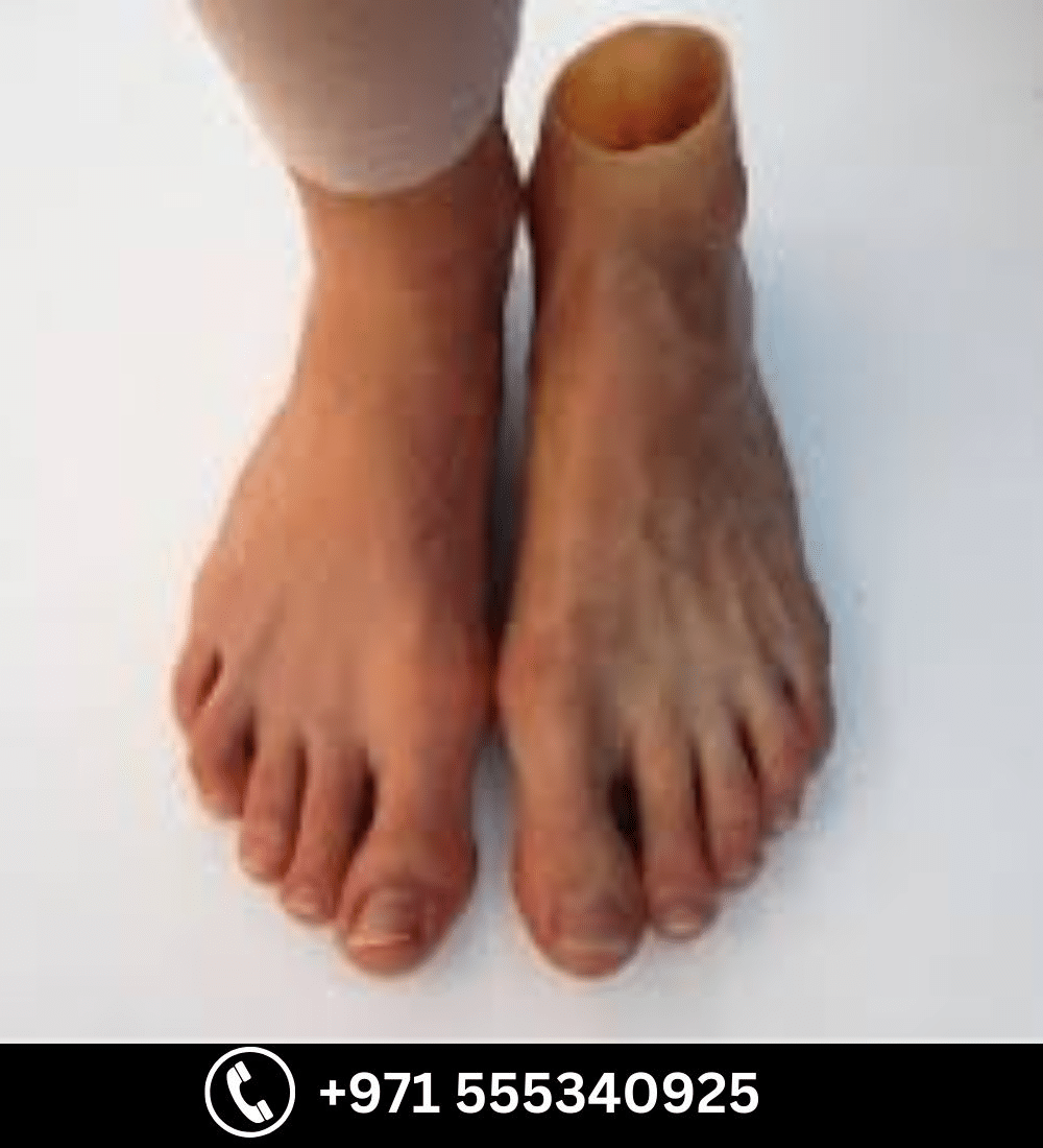 Partial Foot Prosthesis (Foot Amputation) — prosthetic in Dubai | Steps Creators UAE