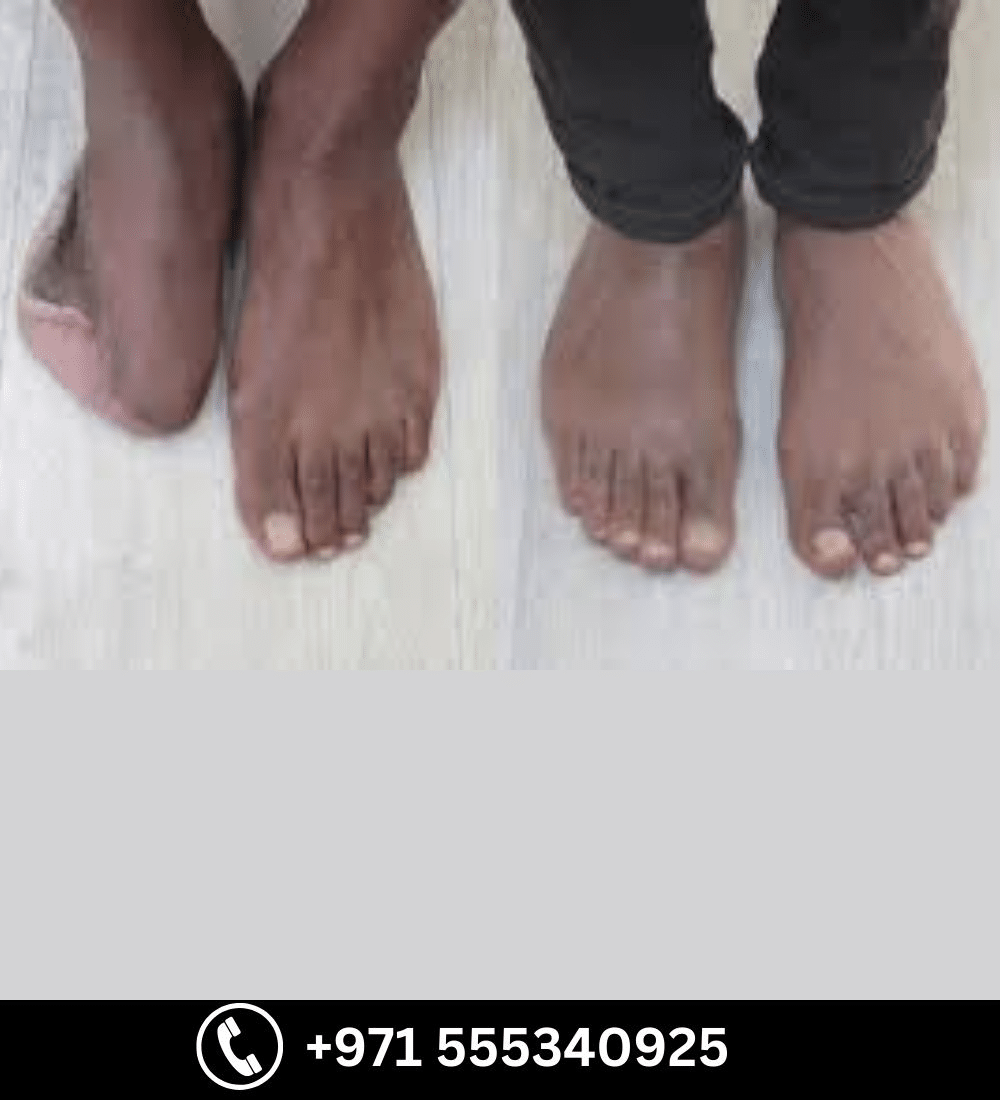 Partial Foot Prosthesis (Foot Amputation) — prosthetic in Dubai | Steps Creators UAE — View 2