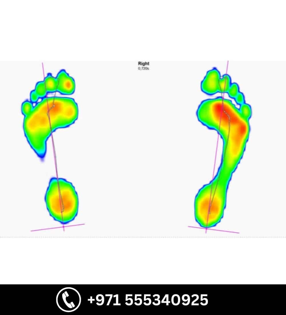 3D Print Custom Made Insole - Lower Limb available at Steps Creators Dubai, UAE