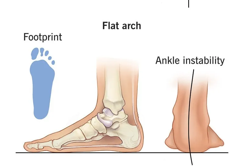 Custom Made Insole Flat-Feet - Custom Made available at Steps Creators Dubai, UAE