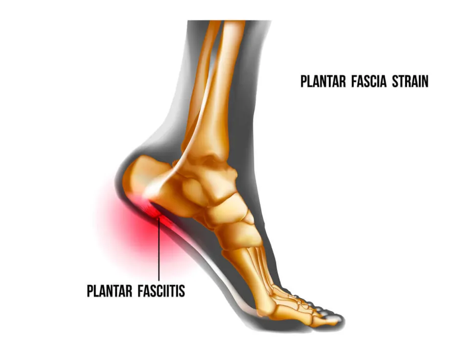 Plantar Fasciitis Custom Made Insole - Custom Made available at Steps Creators Dubai, UAE