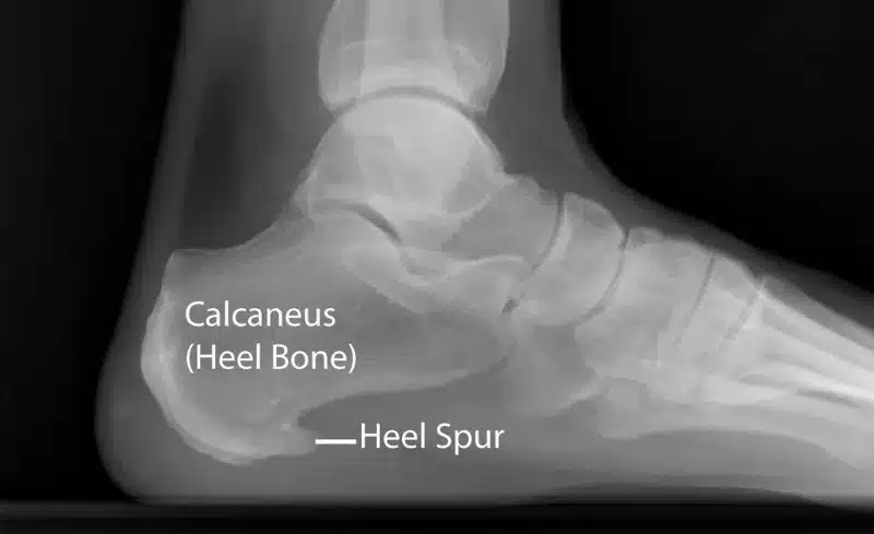 Bone Spur & Plantar Fasciitis - Custom Made available at Steps Creators Dubai, UAE